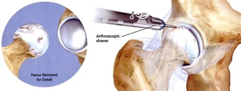 Chondroplasty/Microfracture - UBMD Orthopaedics & Sports Medicine Doctors – Buffalo, Niagara ...