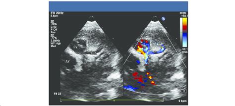 ALCAPA in an infant: TTE showed the LCA originating from the pulmonary ...