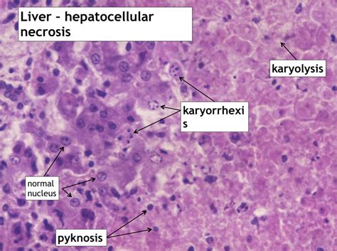 Irreversible Cell Injury - Necrosis Diagram | Quizlet