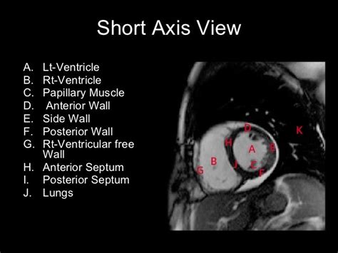 Cardiac mri&slice anatomy