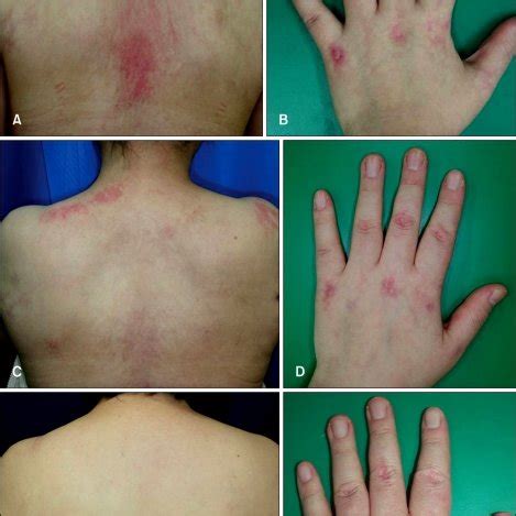 (A) Patient 2 with the Gottron's sign before treatment. (B)... | Download Scientific Diagram