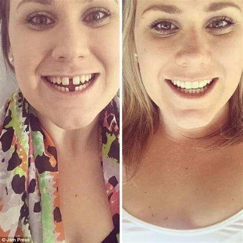 Brace wearers share their before and after pictures | Daily Mail Online