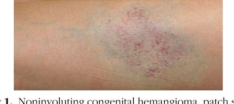 Figure 3 from Characteristics of noninvoluting congenital hemangioma: a retrospective review ...