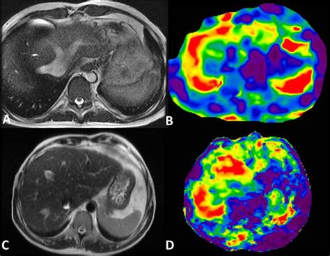 Congestive hepatopathy. Top row-A 36-year-old male with history of... | Download Scientific Diagram