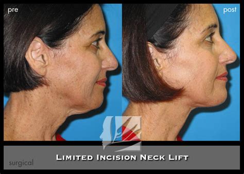 Neck (Limited Incision) - Dr. Prendiville