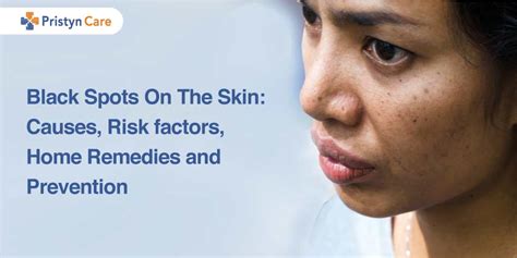 Black Spots On The Skin: Causes, Risk factors, Home Remedies and Prevention