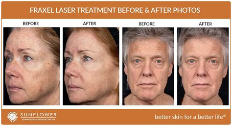 Fraxel Laser After Treatment | atelier-yuwa.ciao.jp