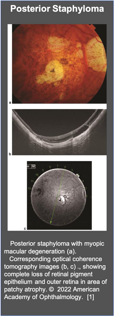 Staphyloma - EyeWiki