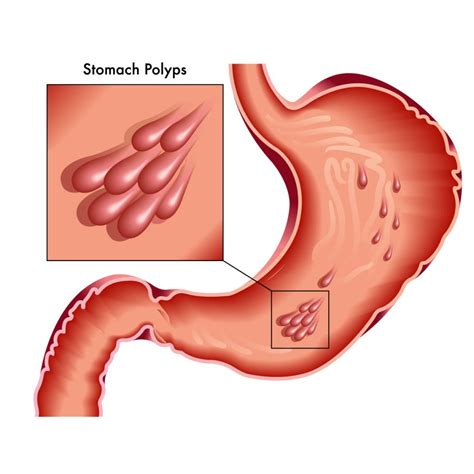 Treatment For Stomach Polyps In Bangkok | Vejthani