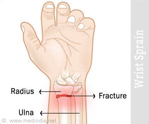 Wrist Sprain - Causes, Symptoms, Diagnosis, Treatment