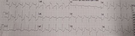 Dr. Smith's ECG Blog: What do you think the echocardiogram shows in this case?