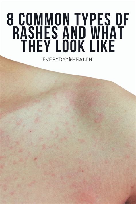 Skin Rashes Due To Heat In Body at Jamie Defranco blog