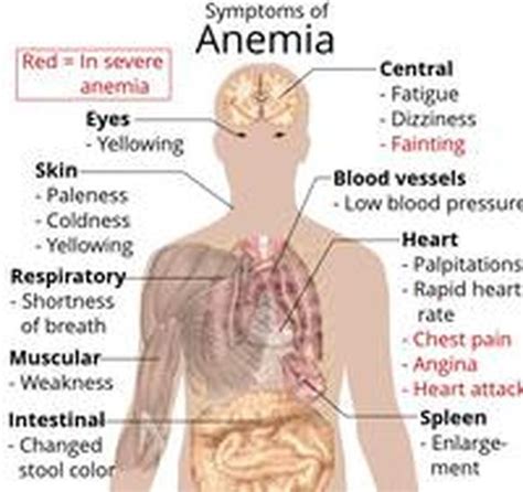 Symptoms - Sickle Cell Disease