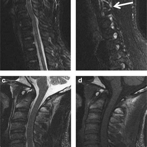 (PDF) MRI in acute and subacute post-traumatic spinal cord injury: Pictorial review