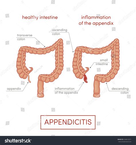 Appendicitis Inflammation Appendix Cartoon Vector Illustration ...