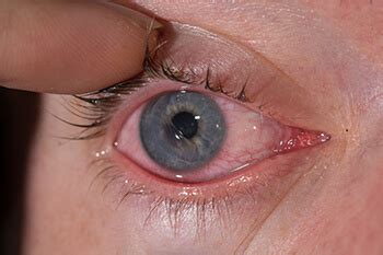 Corneal Abrasion Burlington | Scratched Cornea Plattsburgh, NY