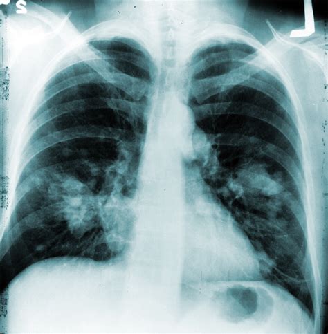 Annual Chest X-rays Don’t Cut Lung Cancer Deaths | National Institutes of Health (NIH)