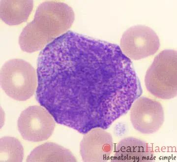 Acute Promyelocytic Leukaemia (APML) - LearnHaem | Haematology Made Simple