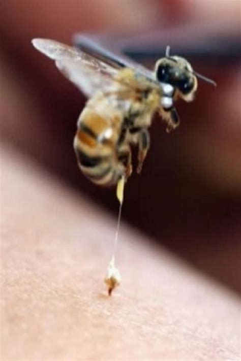 Woman Killed By Bee Sting During Bizarre Acupuncture Therapy #woman # ...