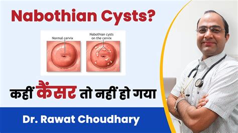 What is Nabothian Cyst | Symptoms of Nabothian Cyst | Homeopathic Treatment of Nabothian Cyst ...