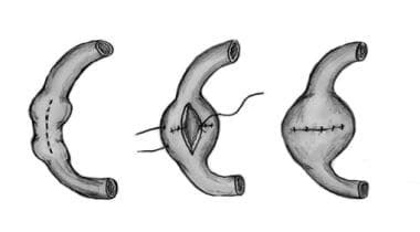 Strictureplasty Technique: Approach Considerations, Heineke-Mikulicz ...