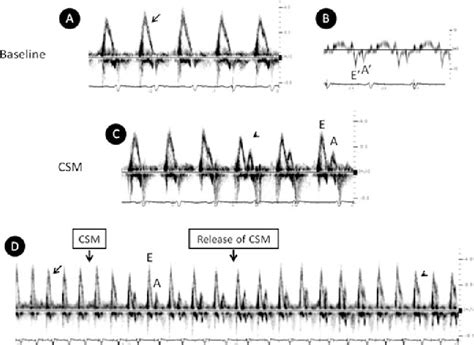 Carotid sinus massage in the echocardiography laboratory. | Semantic Scholar