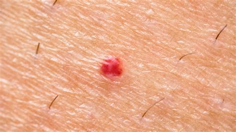 Red Spots On Your Body Can Be Cherry Angiomas: Doctor Says Not A Sign ...