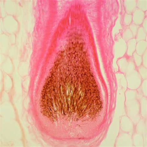 SLA Pharma AG > Therapeutic areas > Pilonidal sinus disease