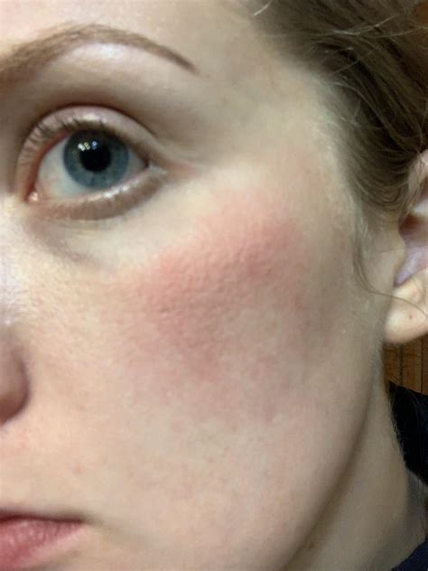 [skin concerns] Superficial frostbite advice? : r/SkincareAddiction