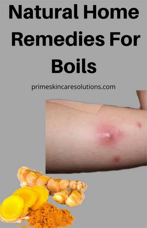 Natural Home Remedies for Boils | Home remedy for boils, Home remedies for skin, Natural ...