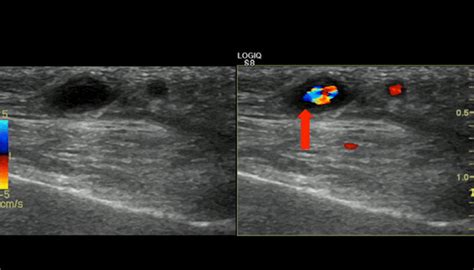 Giant Cell Arteritis Fast Track Clinic - Brigham and Women's Hospital