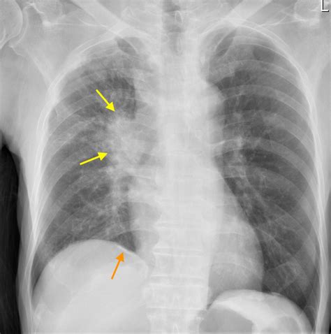 Lung cancer in patient with previous asbestos exposure - Radiology at St. Vincent's University ...