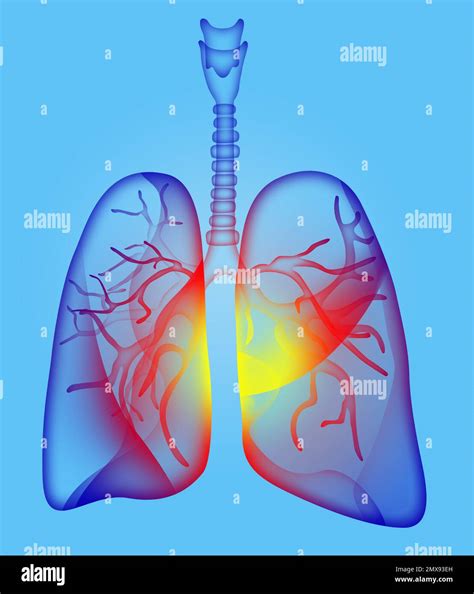 Illustration of human lungs affected with disease on light blue ...