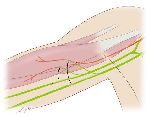 Cureus | Double Fascicular Nerve Transfer to Musculocutaneous Branches for Restoration of Elbow ...