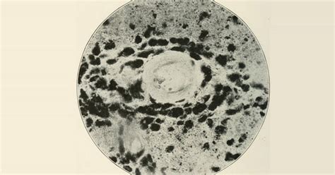 Demyelinating polyneuropathies: what are they, types, symptoms and ...