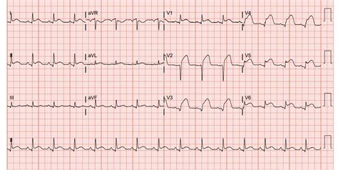 Acute Myocardial Infarction Ekg | My XXX Hot Girl