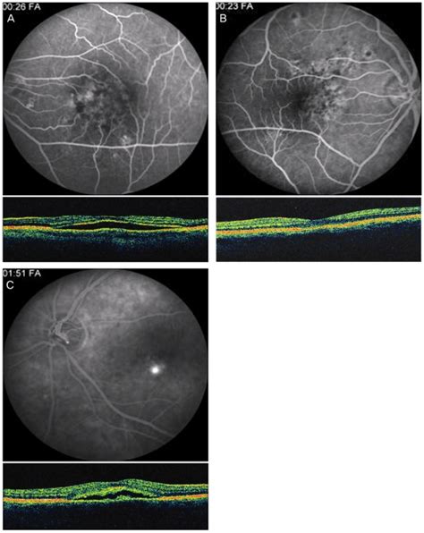 Subgroup of chronic central serous chorioretinopathy (CSCR). (A)... | Download Scientific Diagram