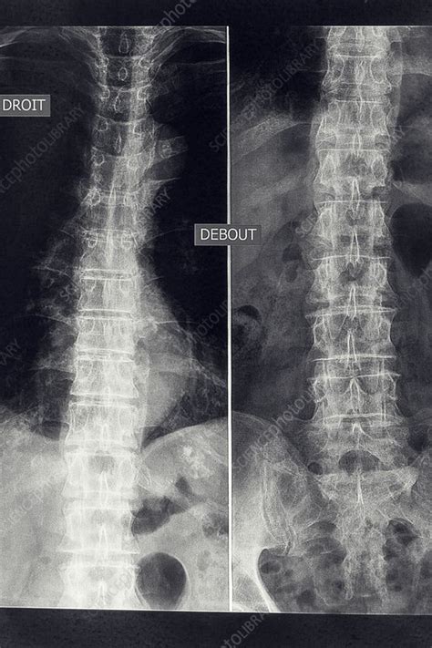 Osteoarthritis of the lumber spine, X-ray - Stock Image - C036/8214 ...