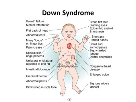 Infants with down syndrome symptoms