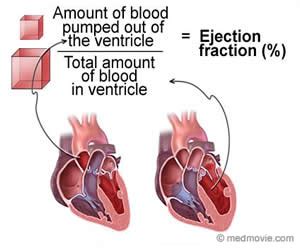 What is Ejection Fraction and Why is is Important