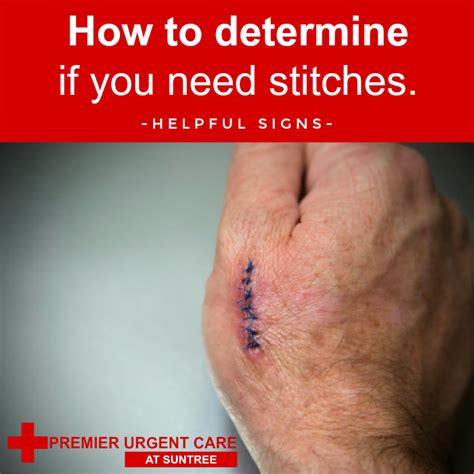 Do Urgent Care Do Stitches : How To Know If Your Cut Needs Stitches Or ...