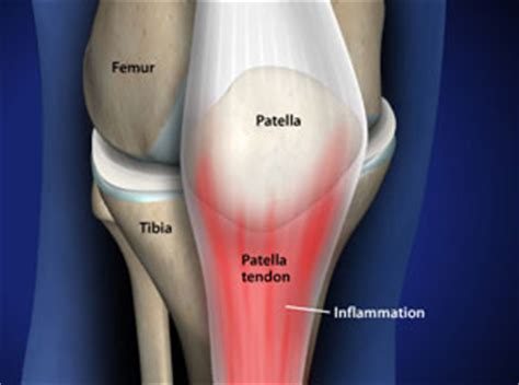 Treating Patellar Tendonitis in Plano, Frisco, McKinney and Allen