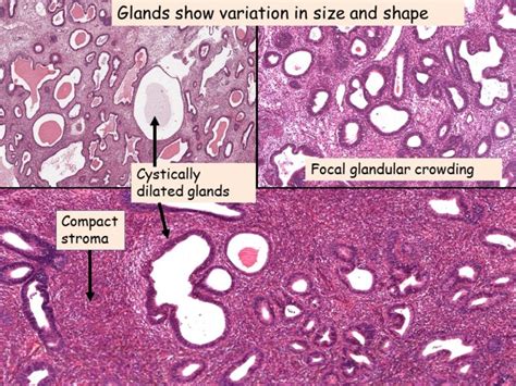 Pathology of Endometrial Hyperplasia - Pathology Made Simple