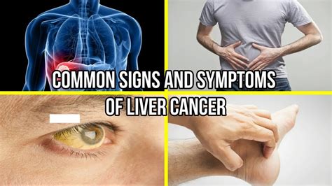 Common Signs and Symptoms Of Liver Cancer - YouTube