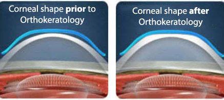 What is orthokeratology (ortho-k)?