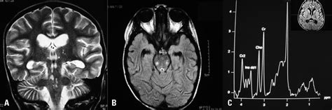 Case 2 MRI and S-MRI showing bilateral lesions on both thalamus, pons ...