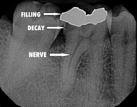 What is a Root Canal, Buildup, and Crown? - AdVance Dental PC | Dentist ...