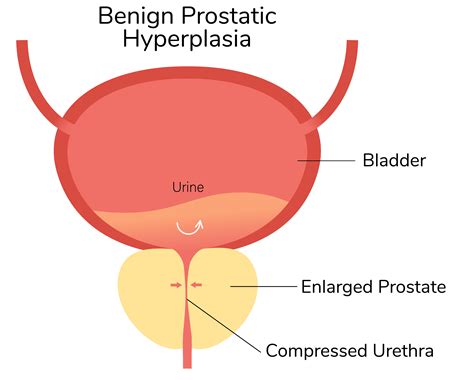 How An Enlarged Prostate Affects Your Sexual Health - MenMD