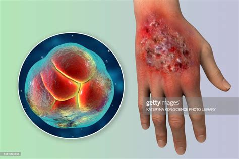 Protothecosis Infection On A Human Hand Illustration High-Res Vector Graphic - Getty Images