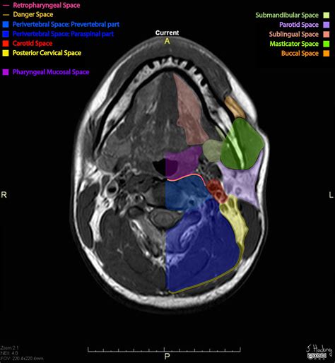 Ct Anatomy Of The Neck Spaces | The Best Porn Website